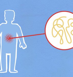 syndrome de l'intestin irritable (SII)