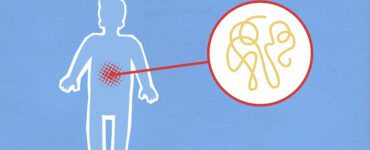 syndrome de l'intestin irritable (SII)