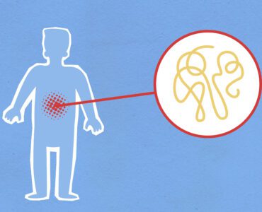 syndrome de l'intestin irritable (SII)