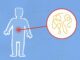 syndrome de l'intestin irritable (SII)